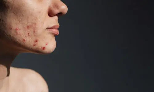 Har du akne - Tips til kosttilskud og en bedre hudplejerutine – Skinfulness