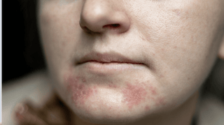 Den store PD-test: Er det akne, rosacea eller Perioral Dermatitis?