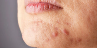 Kvinde med hormonel akne på hagen – guide til bumser på hagen, hormonel ubalance og hudpleje, skrevet af hudterapeut Malin fra Skinfulness