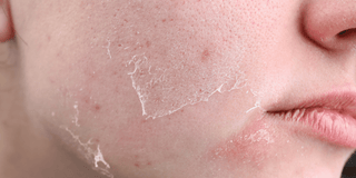 Tør-hud-og-østrogen-hvad-er-sammenhængen skinfulness.dk