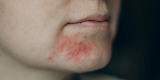 Perioral-Dermatitis-Når-huden-skriger-det-du-ikke-får-sagt Skinfulness