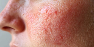 Rosacea – få ro på huden naturligt