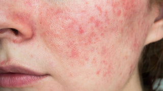 Rosacea-behandling-Få-ro-i-huden-uden-daglig-antibiotika Skinfulness