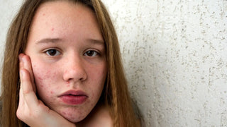 Mor-guiden-til-teen-hud Skinfulness